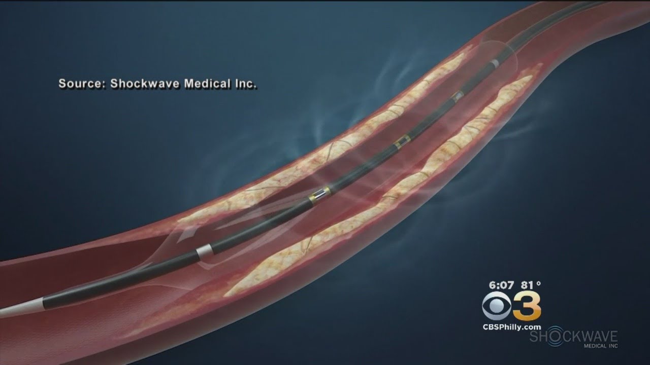 Shockwave Therapy Helping Patients With Peripheral Artery Disease