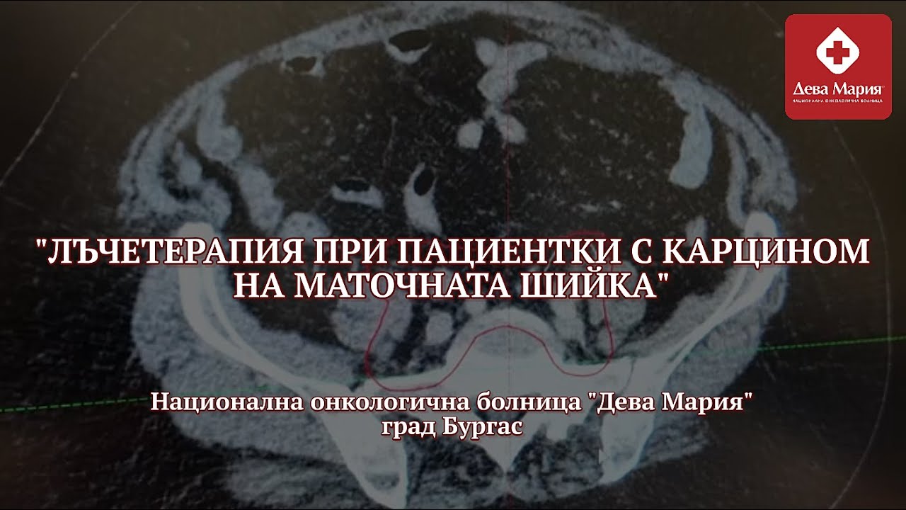 Лъчетерапия при пациентки с карцином на маточната шийка в Национална онкологична болница Дева Мария