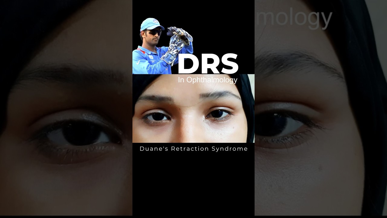 Duane's Retraction Syndrome (DRS) #strabismus