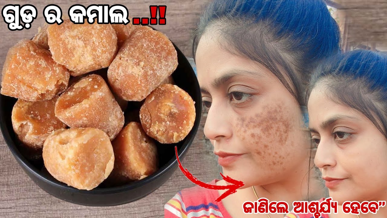 କ୍ରିମ୍ ଦରକାର ନାହିଁ ❌ ମୁହଁରେ ଗୁଡ଼ ଲଗାନ୍ତୁ 😱ପିମ୍ପଲ୍ସ୍ ଓ ଦାଗ ଯିବ ଗୁଡ଼ ଫେସ୍ ପ୍ୟାକ୍ ଚମତ୍କାର‼️7 ଦିନରେ ଗ୍ଲୋ