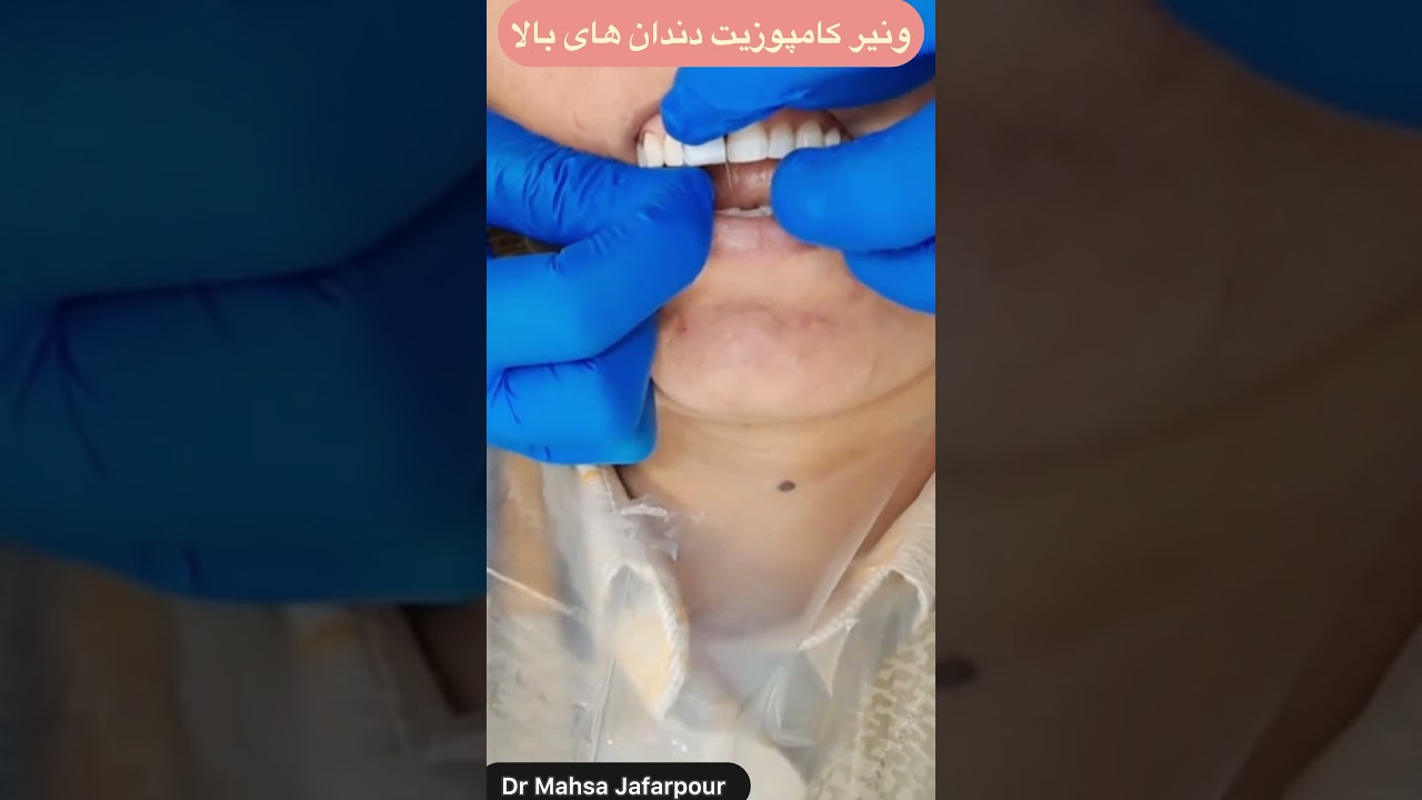 فیلم مراحل انجام ونیر کامپوزیت