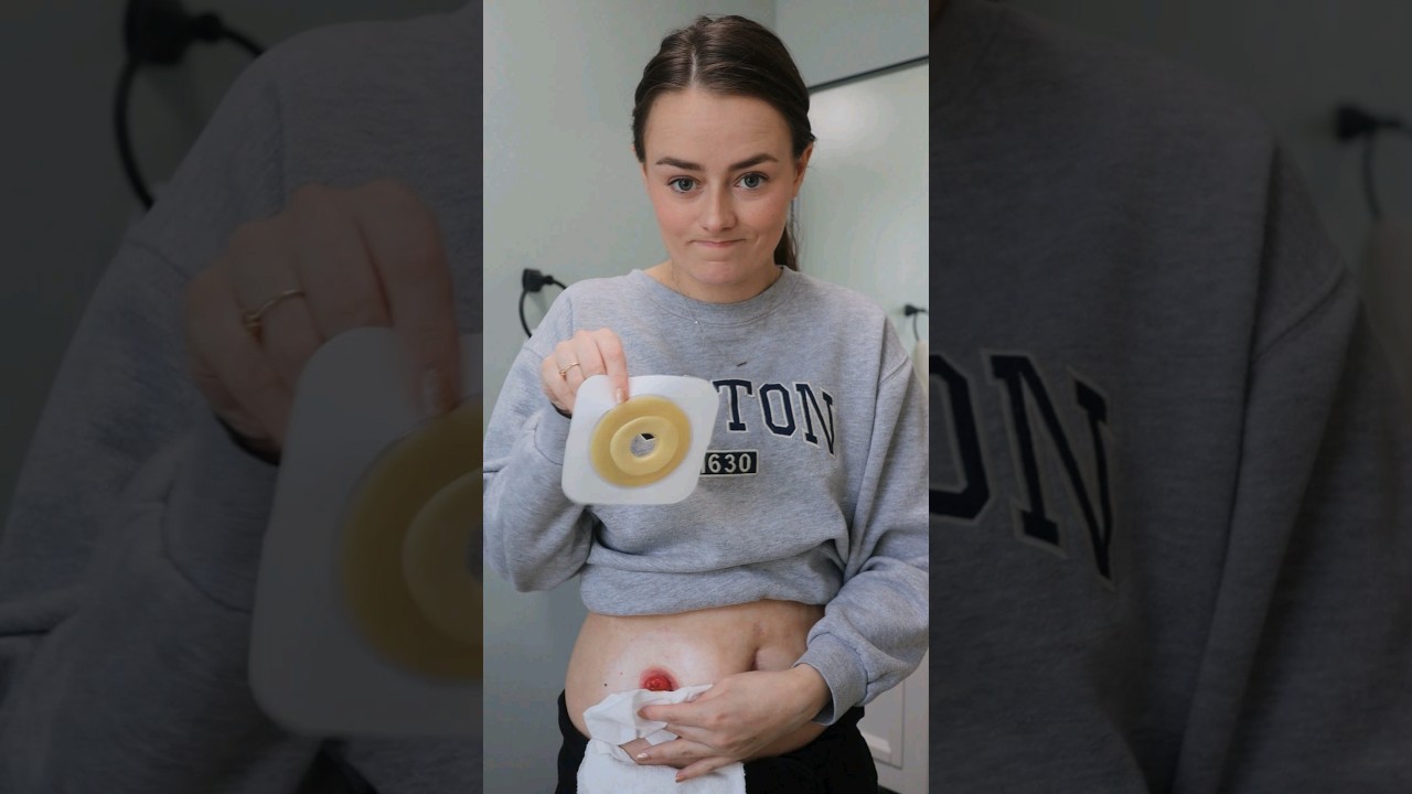 Realistic Ostomy Change - When Your Stoma is a Volcano | #ostomy | Let's Talk IBD