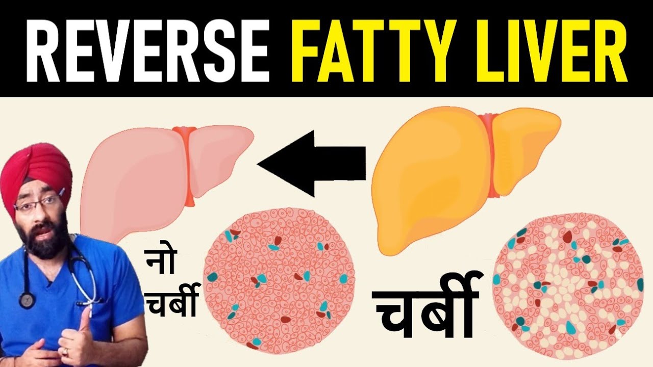 How to Reverse Fatty liver | लिवर से चर्बी कैसे निकले | Dr.Education