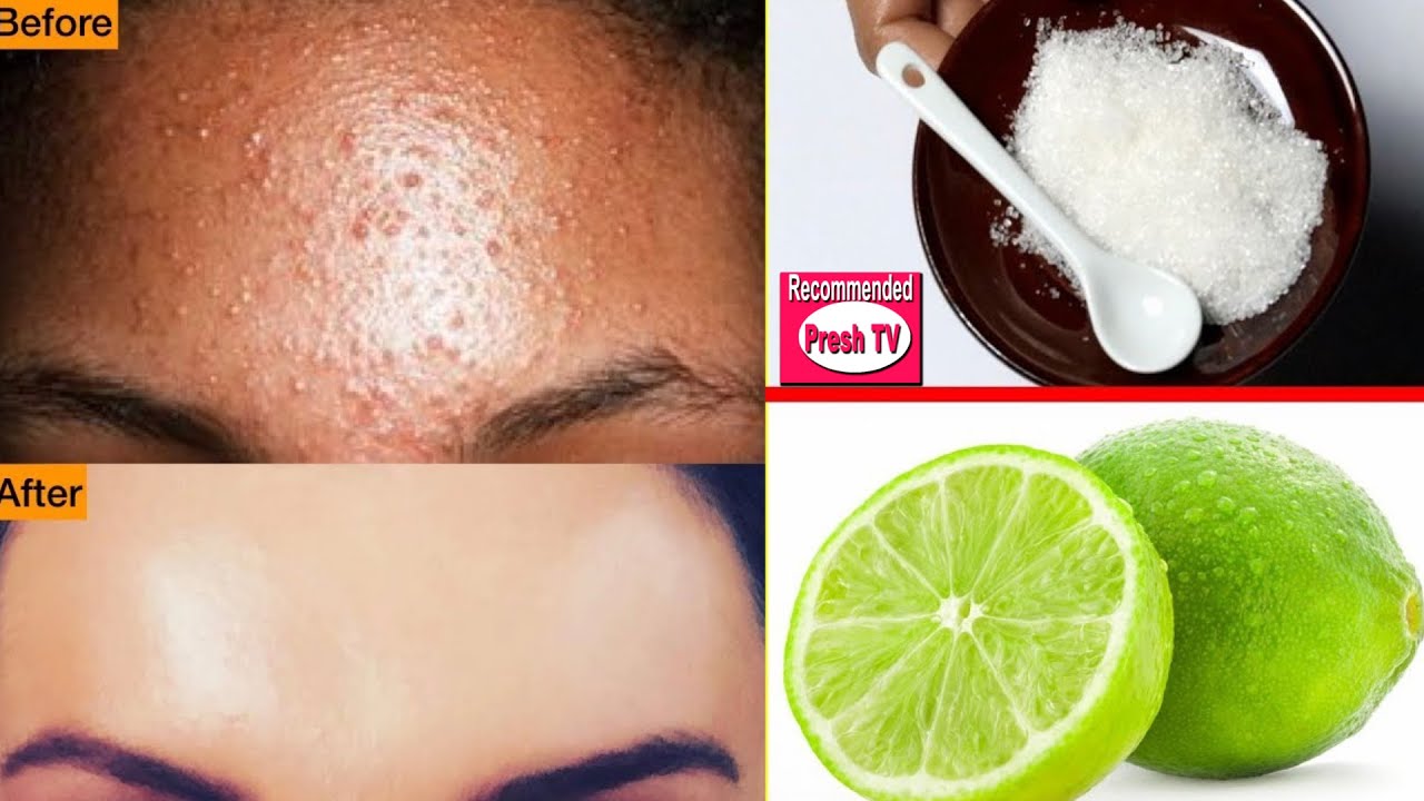 How To Remove Pimples Overnight । Acne Treatment । Remove Pimples Overnight with Lemon (clear skin)