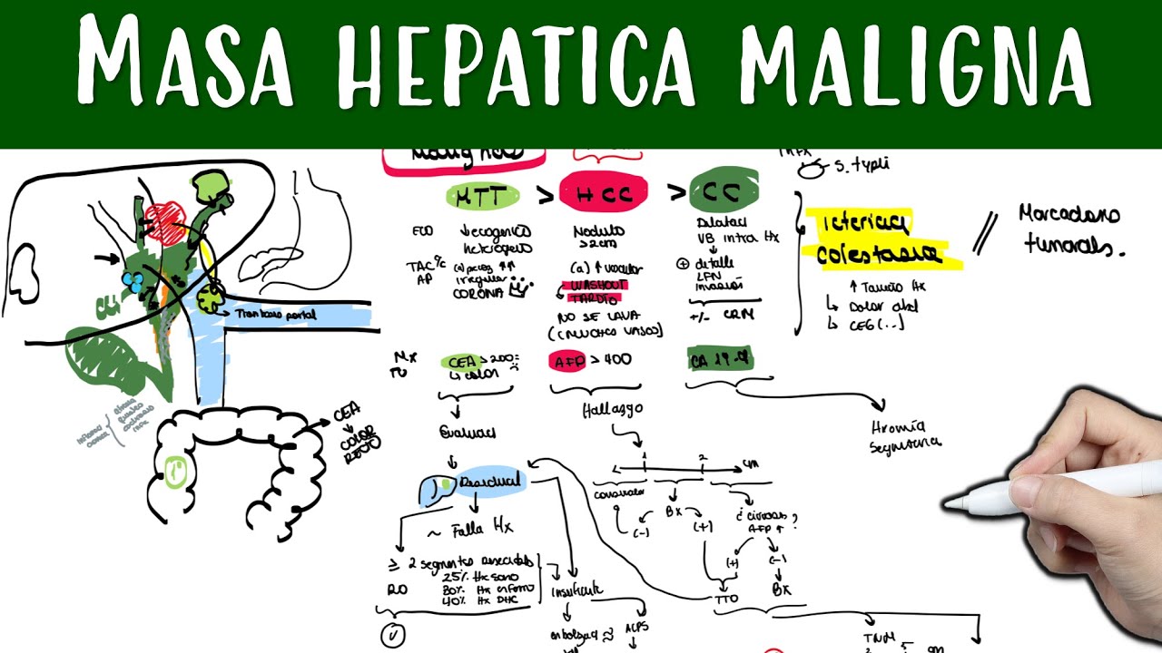 Masa hepatica maligna #Cancer #Metastasis #ColangioCarcinoma #Hepatocarcinoma