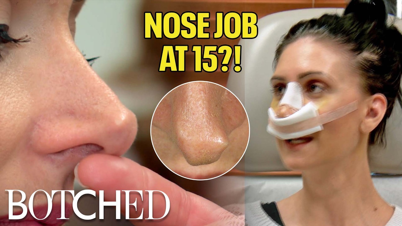 Nose Job at 15?! Edra's Gnarled Nose Made Her Insecurity Even Worse (Before & After) | Botched | E!