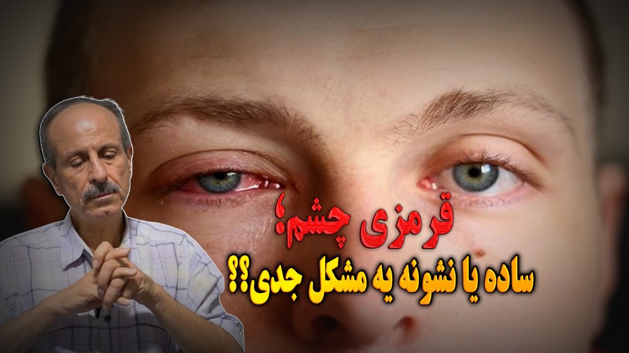 دلایل ایجاد قرمزی در چشم ها | روش های درمان قرمزی چشم ها