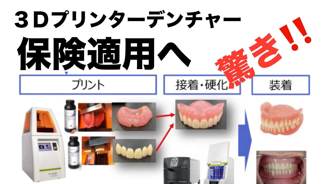 ３Ｄプリンターデンチャー保険適用へ
