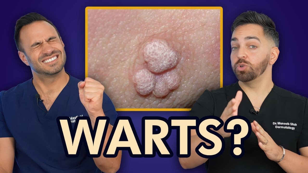 HOW TO TREAT WARTS LIKE A DERMATOLOGIST | EVERYTHING ABOUT WARTS