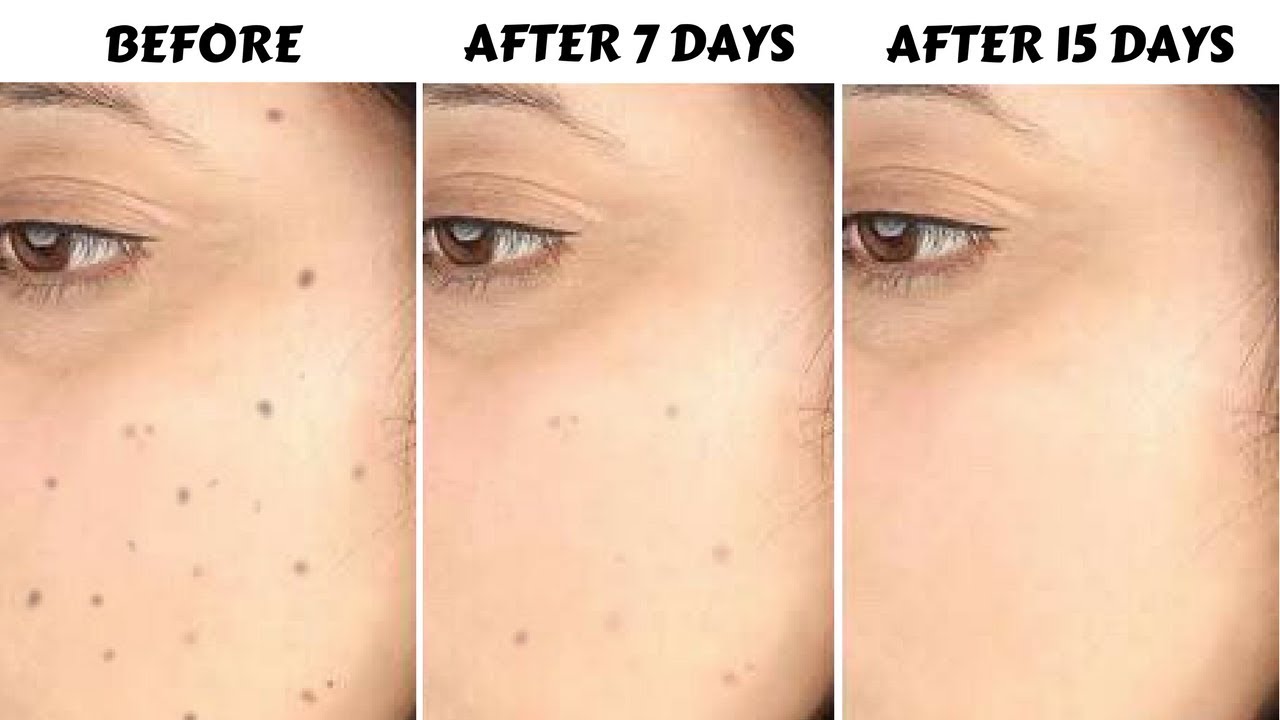 How To Remove Dark Spots, Acne Scars, Pigmentation In Just 7 Days | 100% Natural & Effective