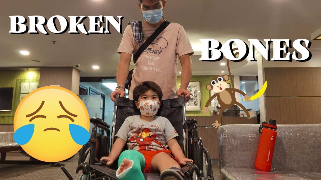 Fracture on 2nd & 3rd metatarsal - Long leg cast application on a toddler