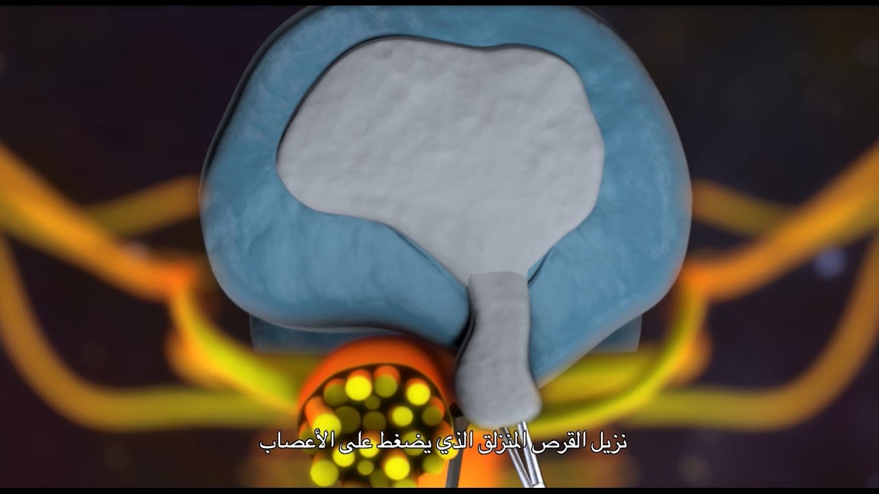 إزالة القرص القطني