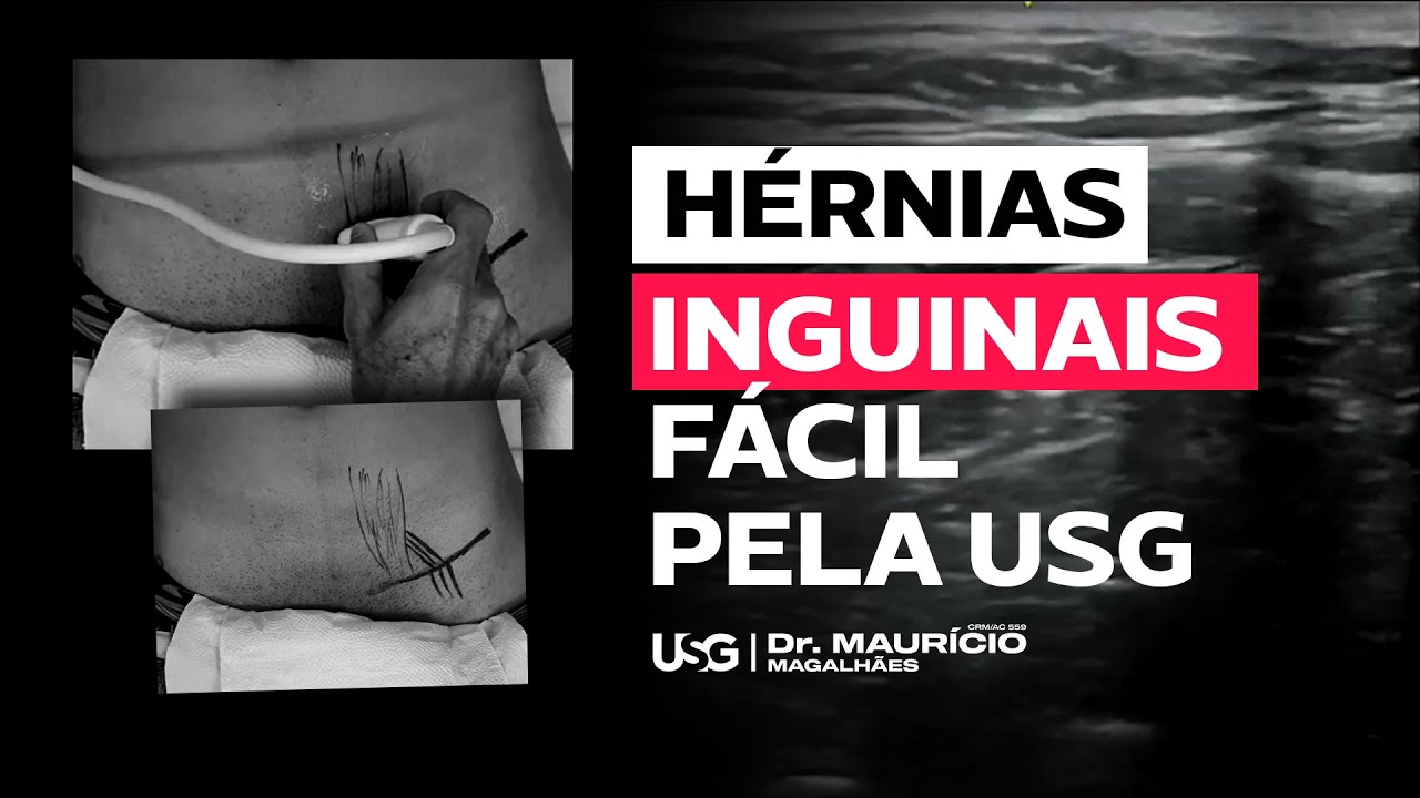 Anatomia e diagnóstico das hérnias inguinais e femoral pela ultrassonografia