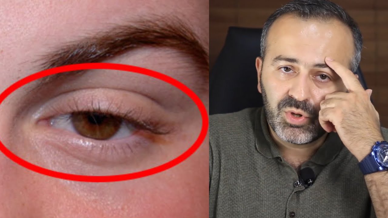 Göz qapağının sallanması - Ptozis Xəstəliyi