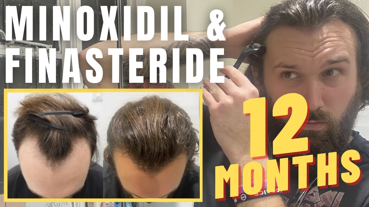 Minoxidil & Finasteride - 12 Month Update! | Christopher Painter