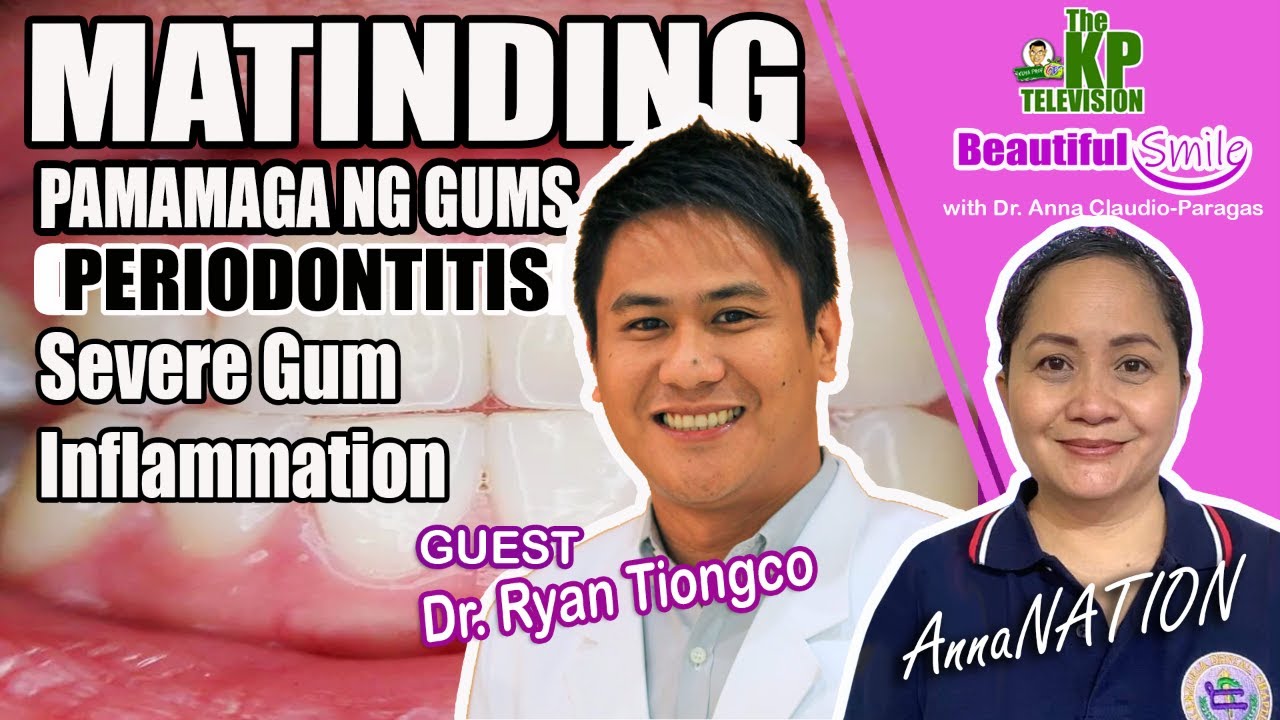 MATINDING PAMAMAGA NG GUMS (PERIODONTITIS)