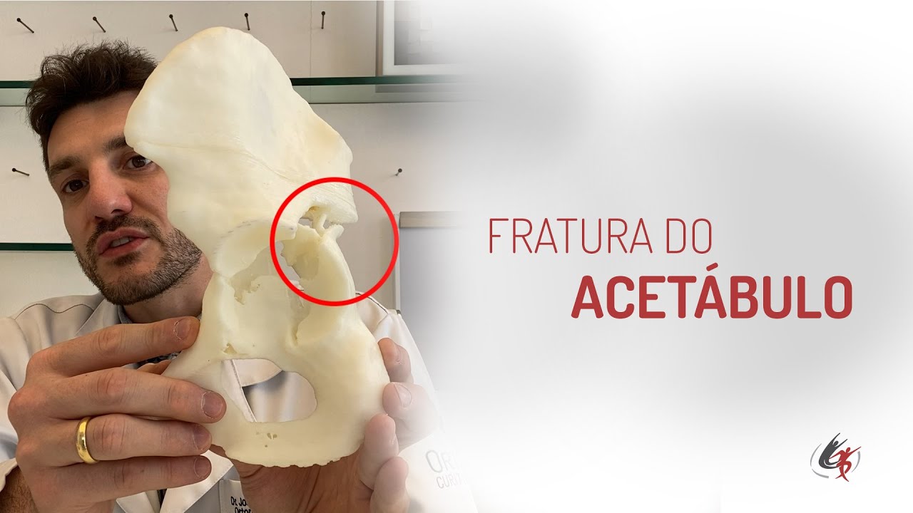Fratura do acetábulo - Causas e tratamentos