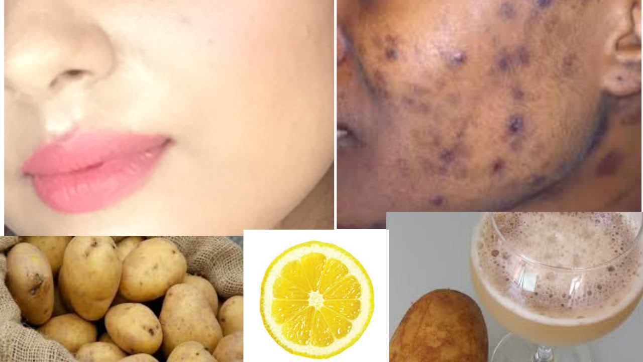 How to Remove BLACK SPOTS , DARK SPOTS & ACNE SCARS on face |ONLY in 5 days | TANUTALKS |
