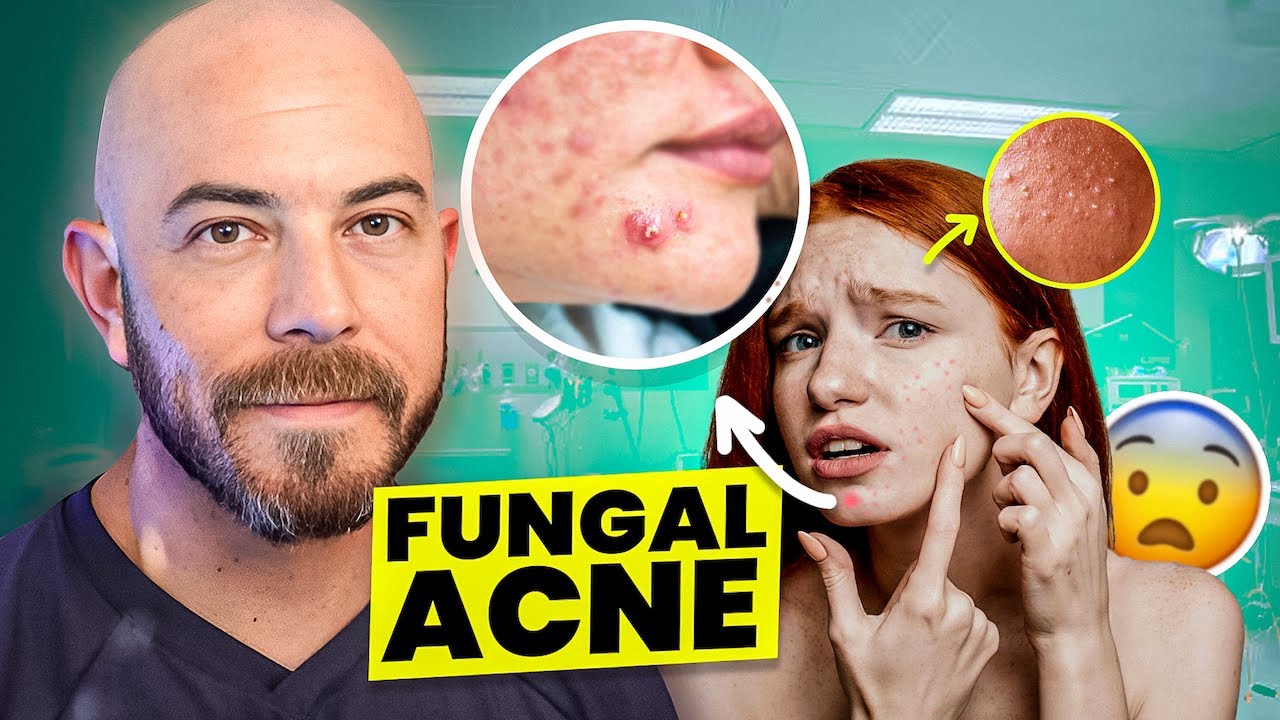 The Best Fungal Acne Treatments Of 2025