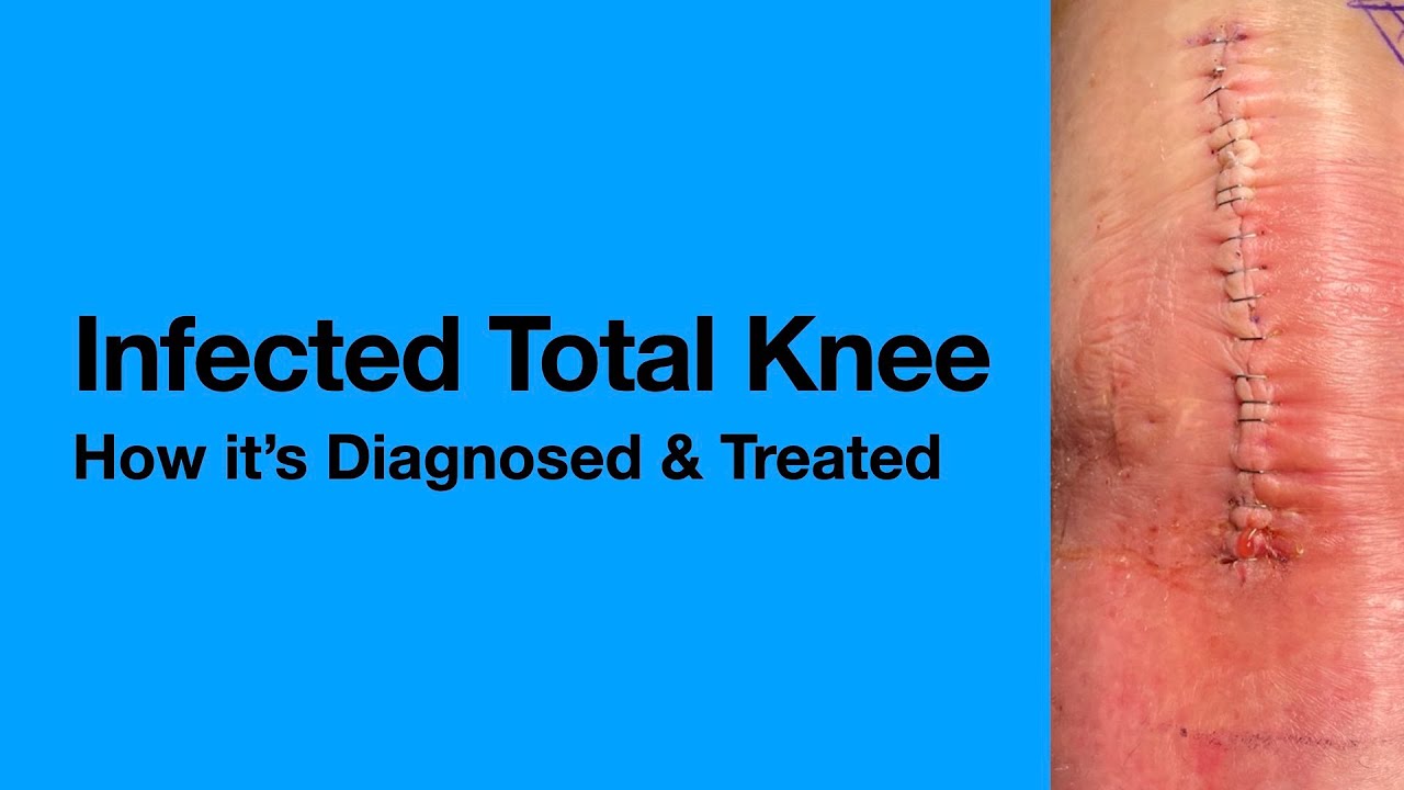 Infected Knee Implants: What Patients Must Know