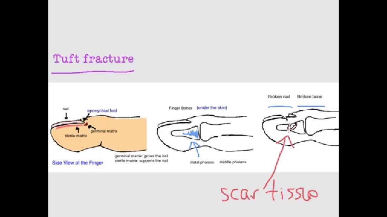 BoneTalks - FingerTip and Nailbed Injuries (Tuft Fracture)