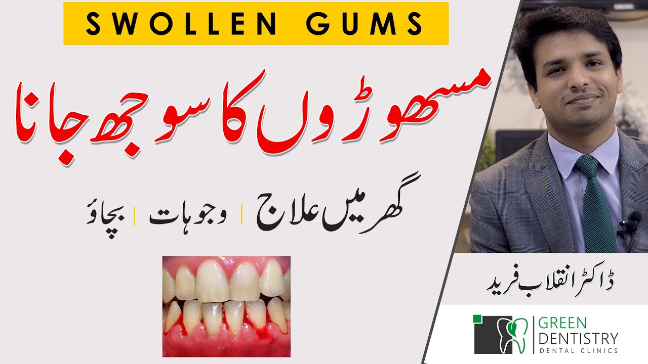 مسھوڑوں کا سوجھ جانا | Never Get Gum Swelling Again!  | Home Treatment | Urdu | Hindi |