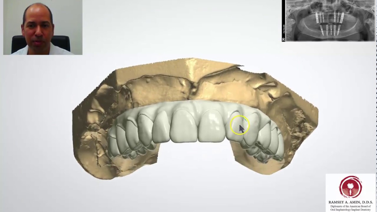 Full Arch All on 4, 5, 6, 7, 8 Implants - 3D Lab Teeth Design Video