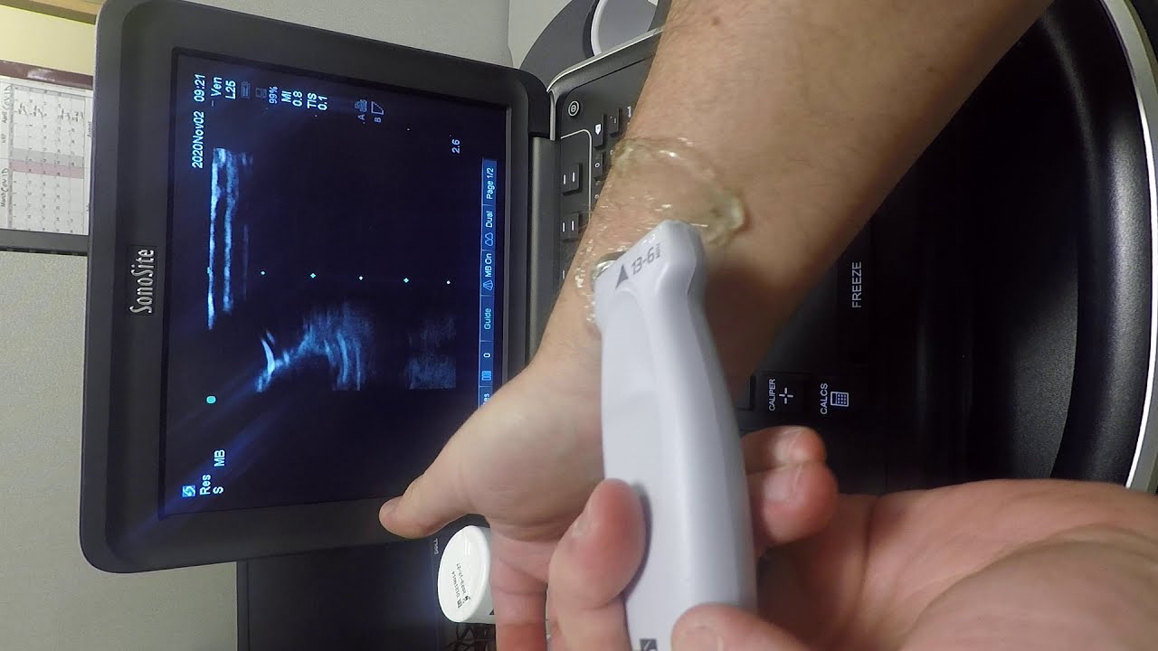 Anatomic overview of radial artery site using ultrasound, Alberta Health Services