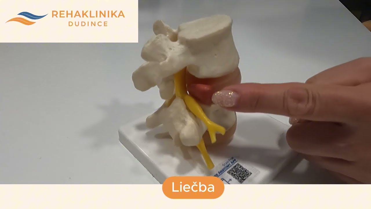 Hernia a protrúzia v driekovej chrbtici: Príčiny, príznaky a liečba | Rehaklinika