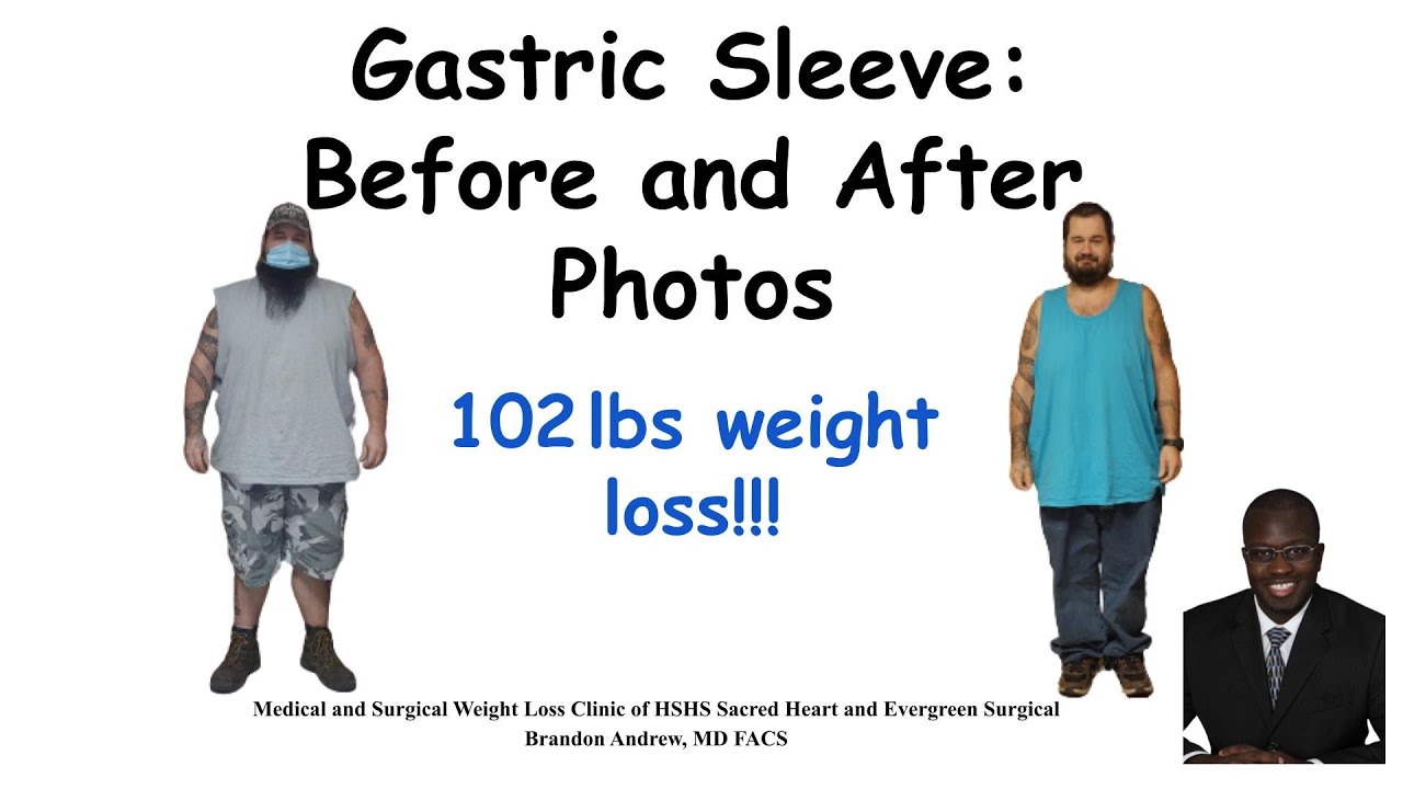Gastric Sleeve Before and After Pictures and Results part 2 | Bariatric Weight Loss Journey