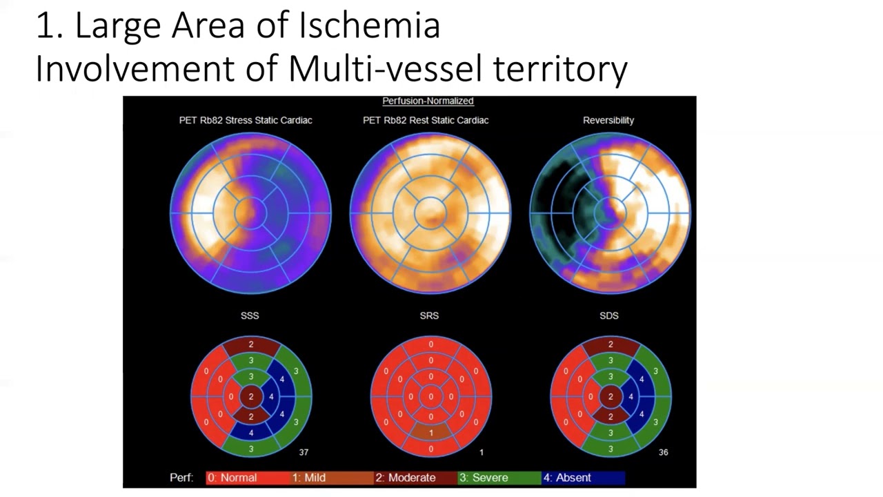 PET stress Perfusion Imaging: Identify all markers of high risk scan
