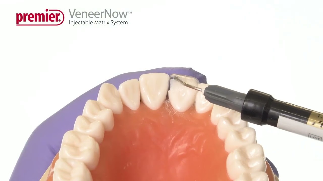 VeneerNow™ Injectable Matrix System - Restoration of a Fractured Incisor or Class IV Restoration