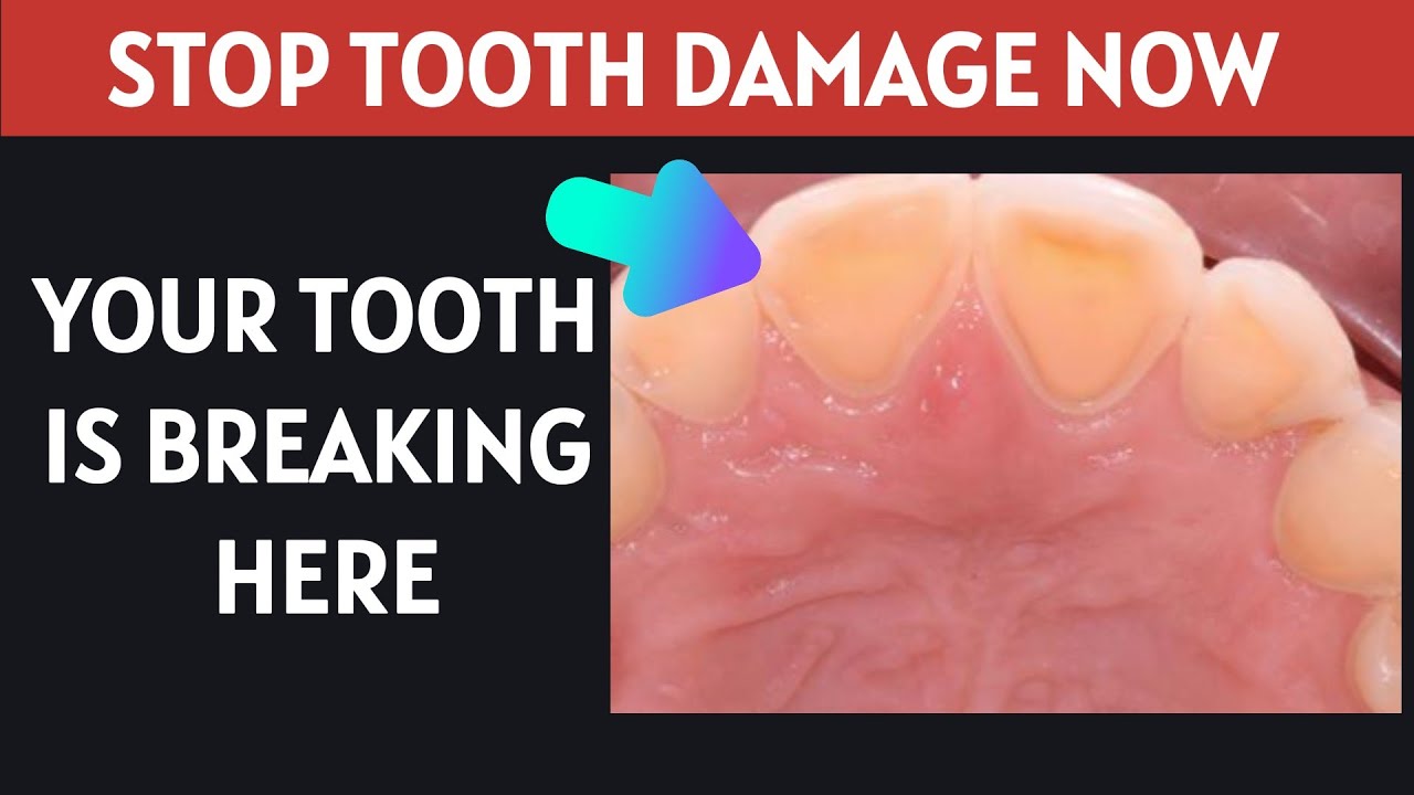 From Notches to Normal: Complete Guide to Tooth Neck Wear.