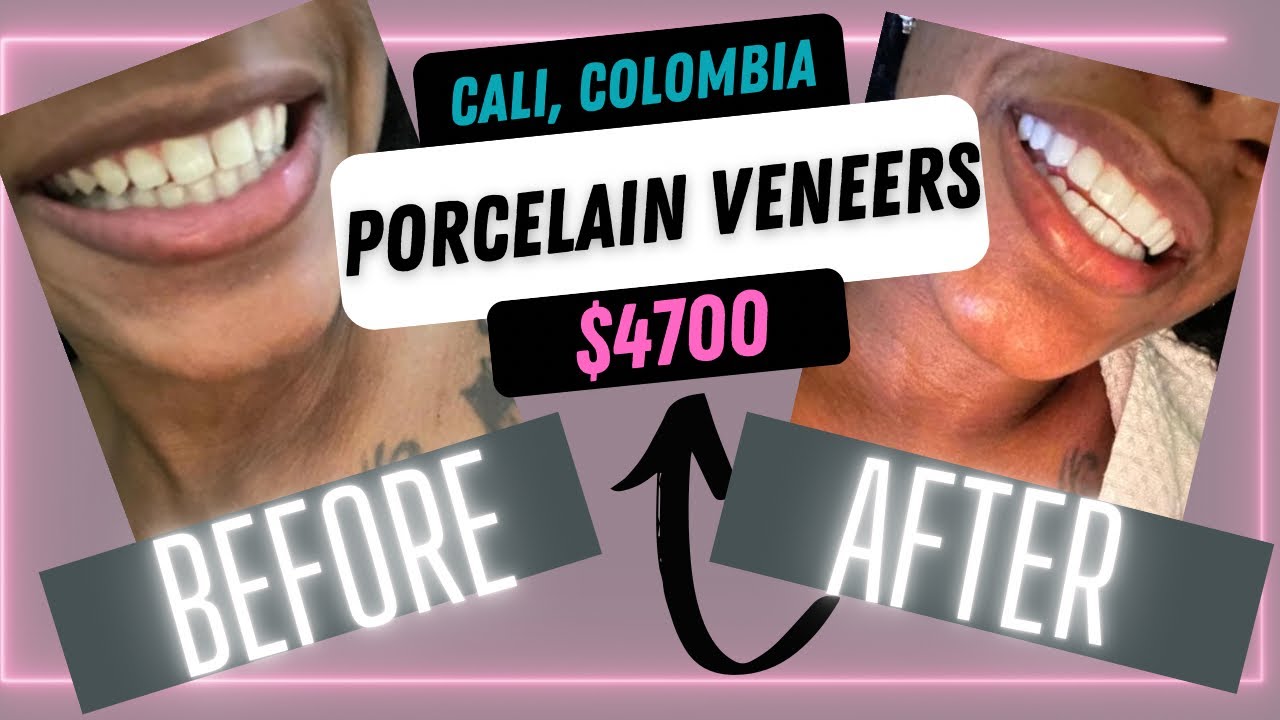 Cali, Colombia 🇨🇴 | Porcelain Veneers| Less than $5K