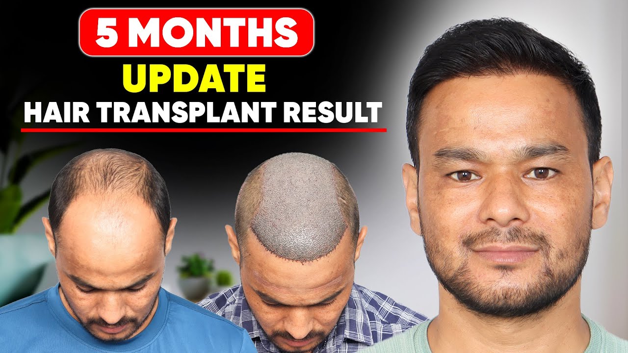 Best Hair Transplant in Delhi (HX-DSHG) | Best Results & Cost of Hair Transplant in Delhi.