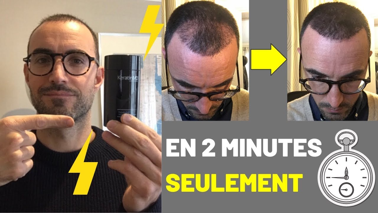 Greffe de cheveux : Le REMÈDE ANTI-CHUTE de Cheveux Post-Intervention 😱