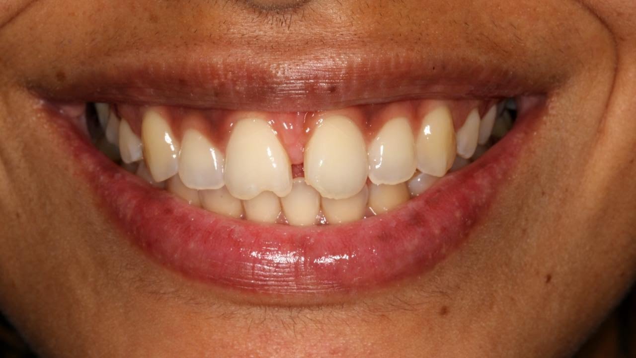 Rapper Siya’s Smile Makeover