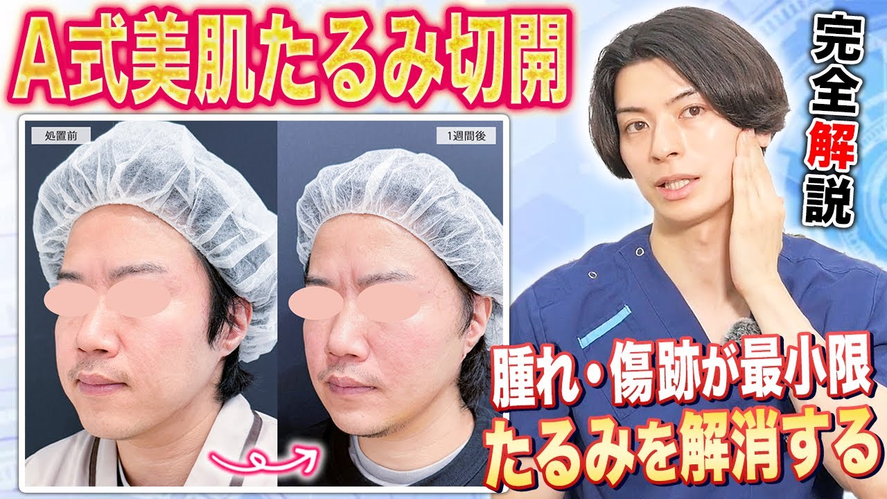 フェイスリフトで顔のたるみ改善！A式美肌たるみ切開について解説！