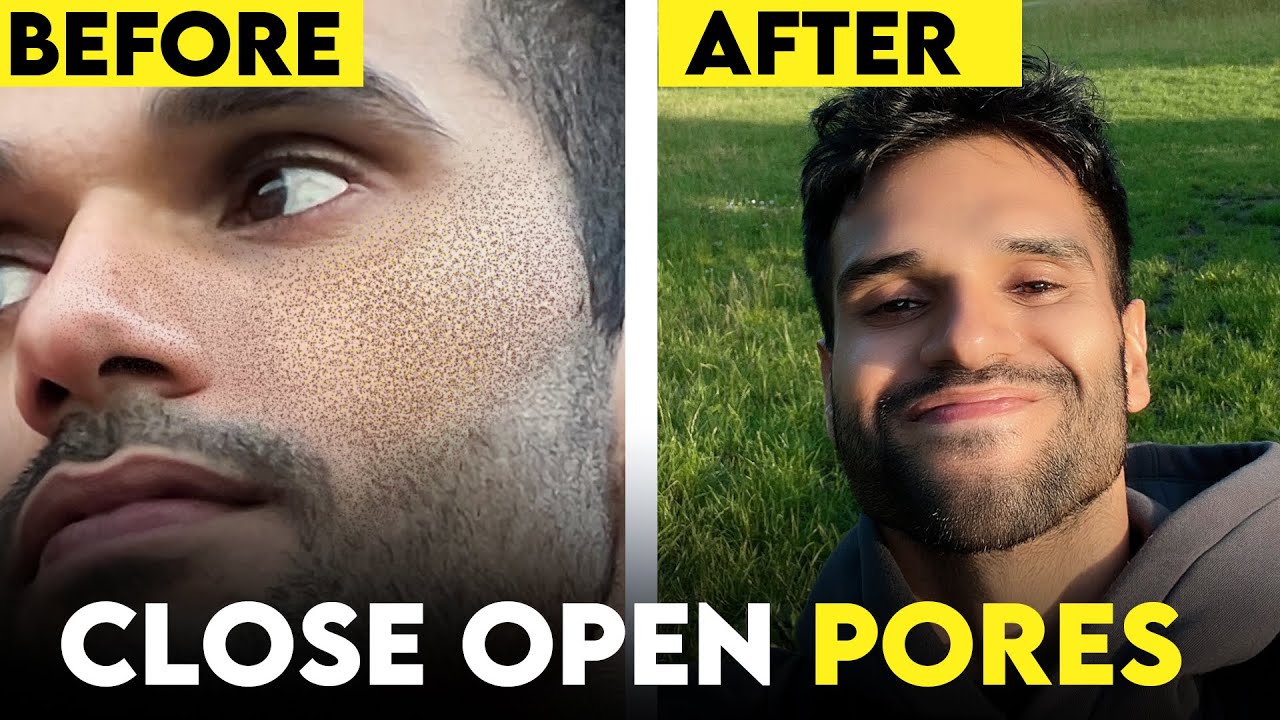 Open Pores Solution - Natural vs Chemical Skin Care Routine | ❌ Clogged Pores | BeYourBest Skincare