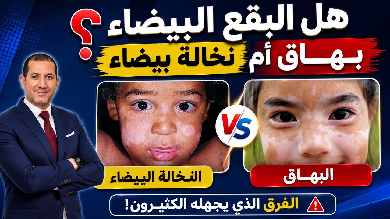 الفروق بين البهاق & النخالة البيضاء: الأسباب الأعراض التشخيص العلاج #د_سامح_البكري