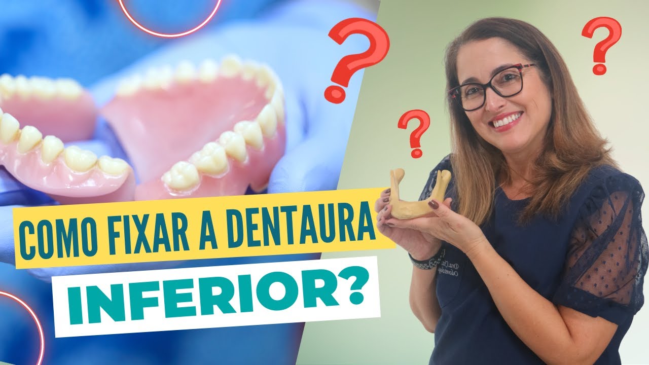 Como fixar a dentadura inferior? Adornare Odontologia Estética em Santos