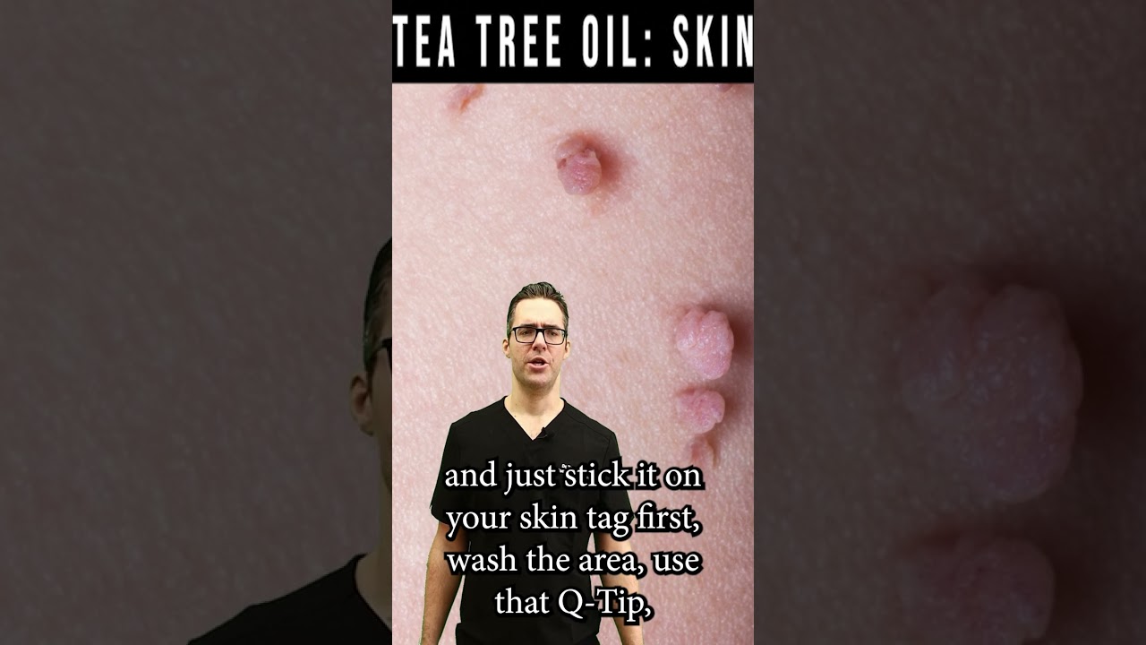Skin Tag Removal & Wart Removal [Tea Tree Oil Natural Remedy]