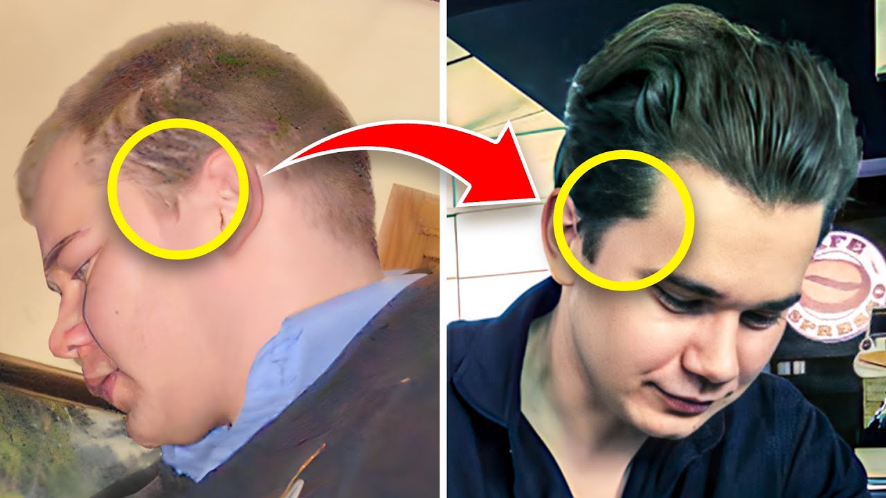 Retrograde Alopecia - How To Fix It | Is It The Same As DUPA?