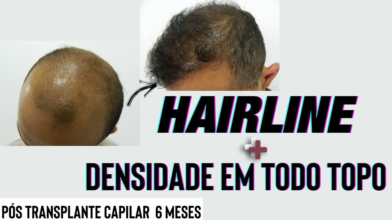 Resultado real 6 meses após transplante capilar #fue ? Calvície grau VI / VII Importancia  Hairline