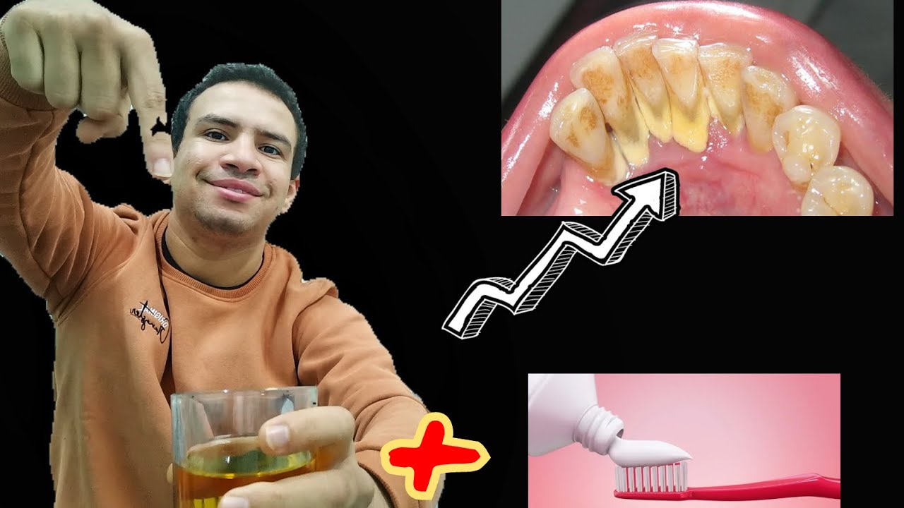 اسرع وصفه ( مجربه) للتخلص من حساسيه الاسنان للابد