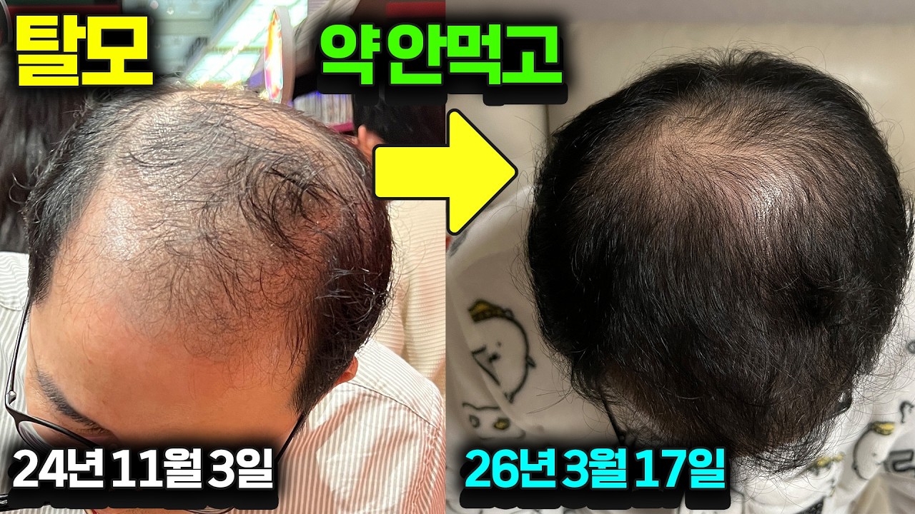 탈모치료, 약 안먹고 샴푸와 바르는 약만으로 이만큼 나아졌습니다