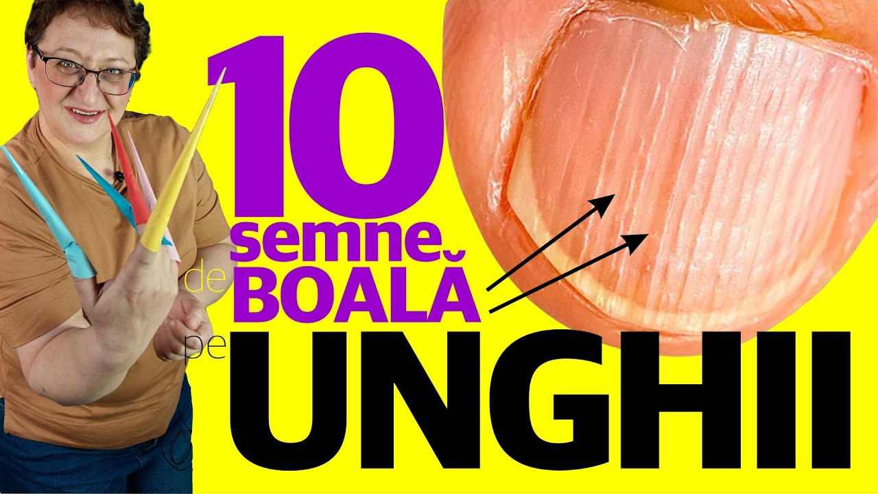 10 Semne pe UNGHII care te trimit la DOCTOR