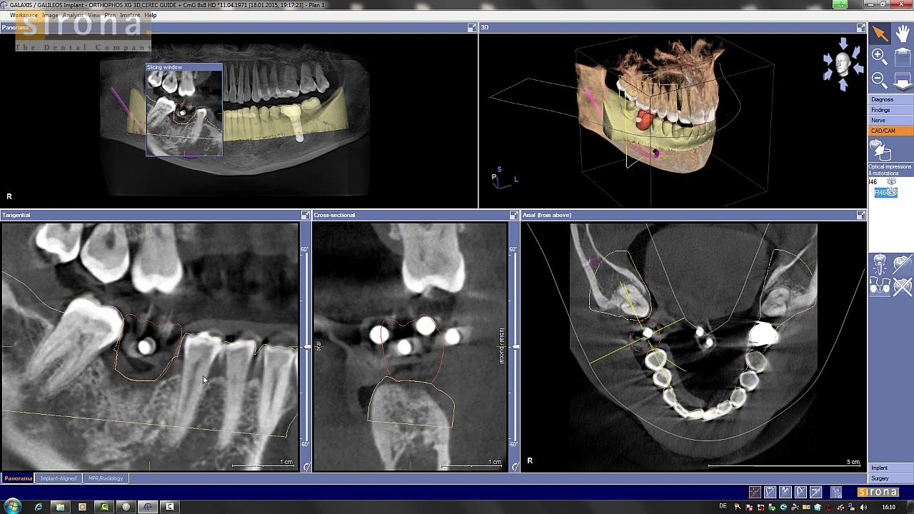 CEREC Guide 2 Implant Planning