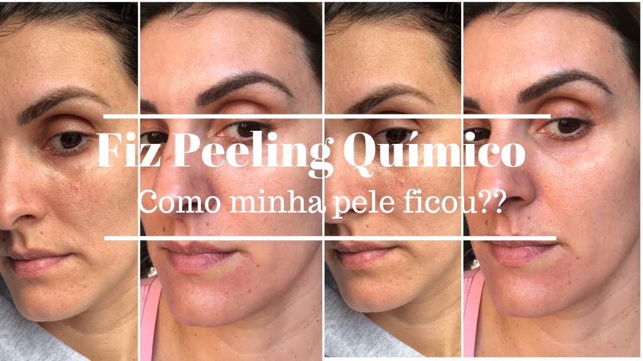 PEELING QUÍMICO ! MINHA EXPERIÊNCIA, ANTES E DEPOIS ! Nati Nahas