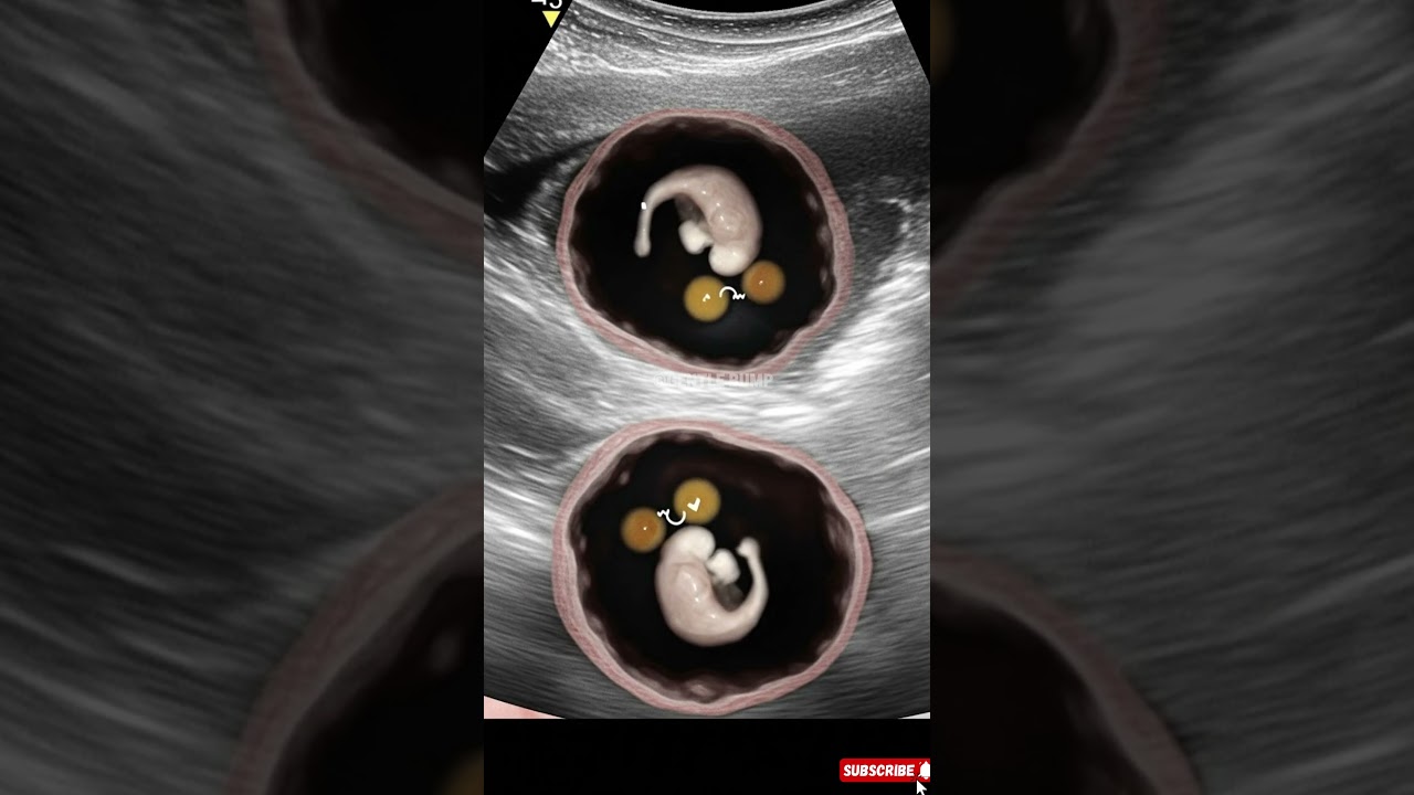 4 Weeks Pregnant: What a Baby Looks Like in the Womb